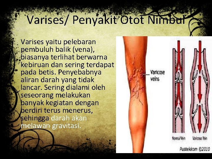 Varises/ Penyakit Otot Nimbul Varises yaitu pelebaran pembuluh balik (vena), biasanya terlihat berwarna kebiruan