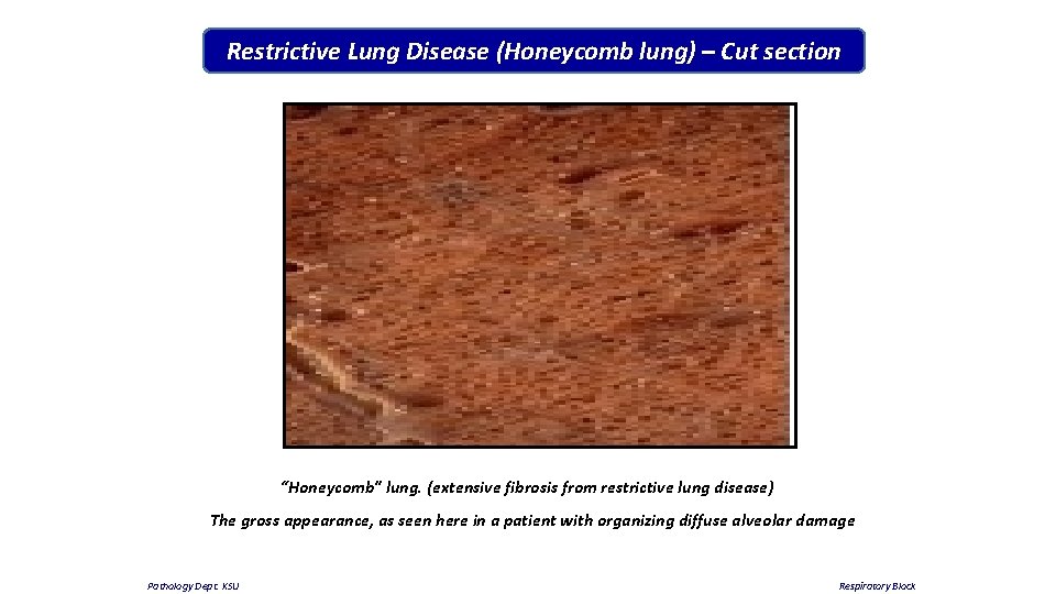 Restrictive Lung Disease (Honeycomb lung) – Cut section “Honeycomb" lung. (extensive fibrosis from restrictive