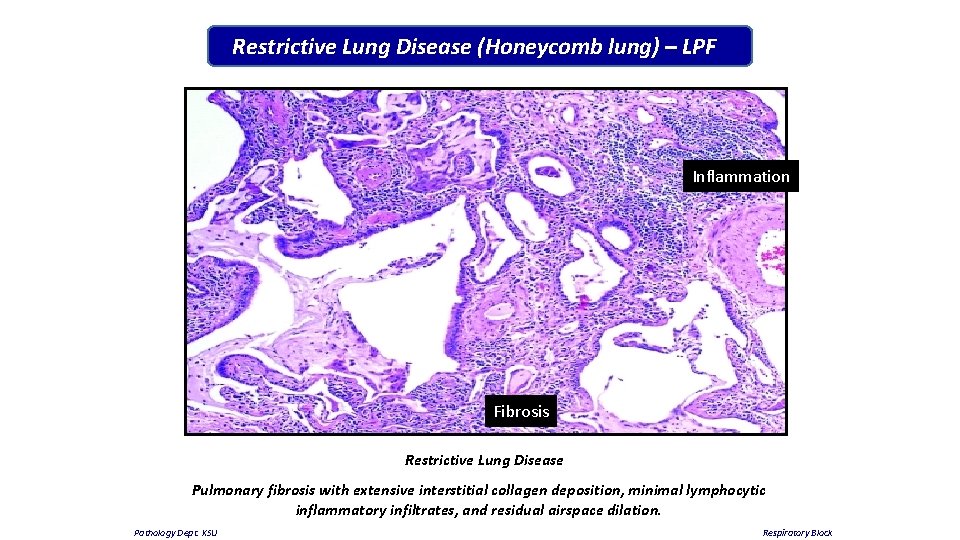 Restrictive Lung Disease (Honeycomb lung) – LPF Inflammation Fibrosis Restrictive Lung Disease Pulmonary fibrosis