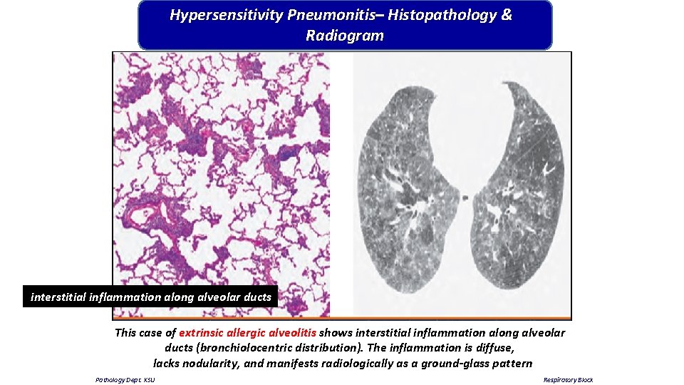 Hypersensitivity Pneumonitis– Histopathology & Radiogram interstitial inflammation along alveolar ducts This case of extrinsic