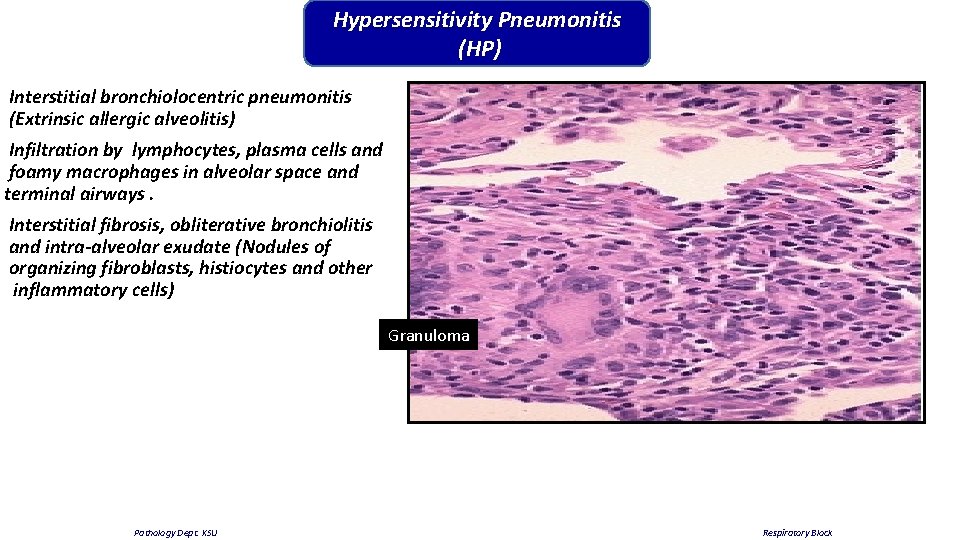 Hypersensitivity Pneumonitis (HP) Interstitial bronchiolocentric pneumonitis (Extrinsic allergic alveolitis) Infiltration by lymphocytes, plasma cells