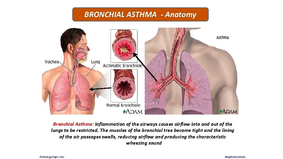 BRONCHIAL ASTHMA - Anatomy Bronchial Asthma: Inflammation of the airways causes airflow into and