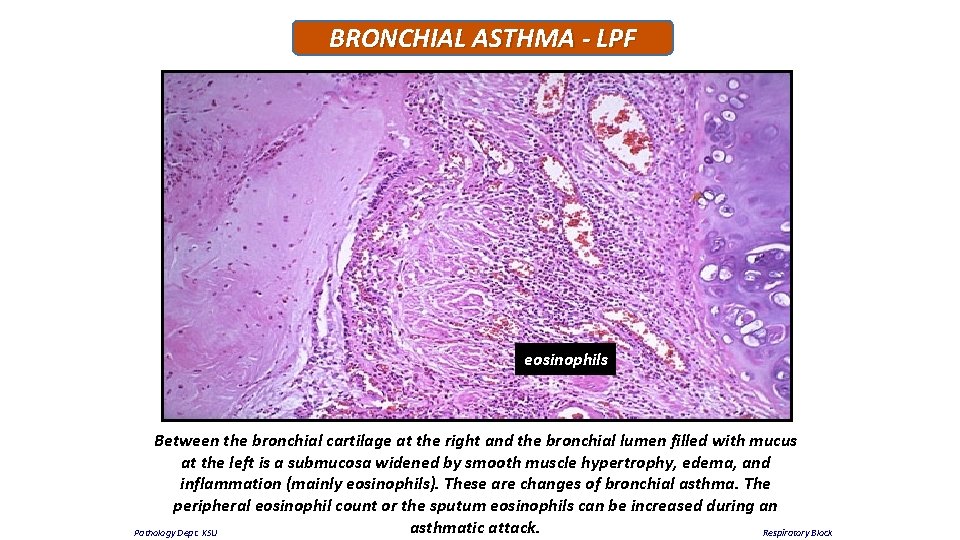 BRONCHIAL ASTHMA - LPF eosinophils Between the bronchial cartilage at the right and the