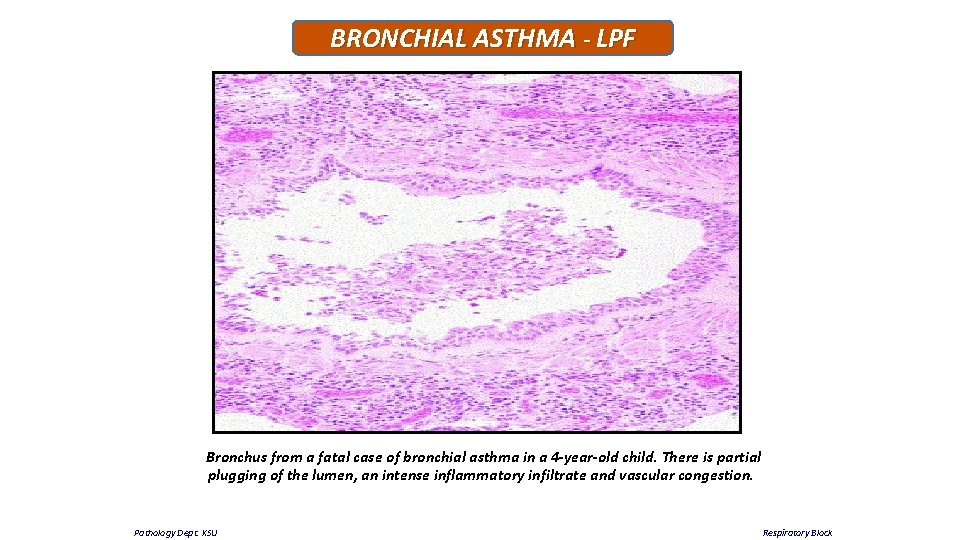 BRONCHIAL ASTHMA - LPF Bronchus from a fatal case of bronchial asthma in a