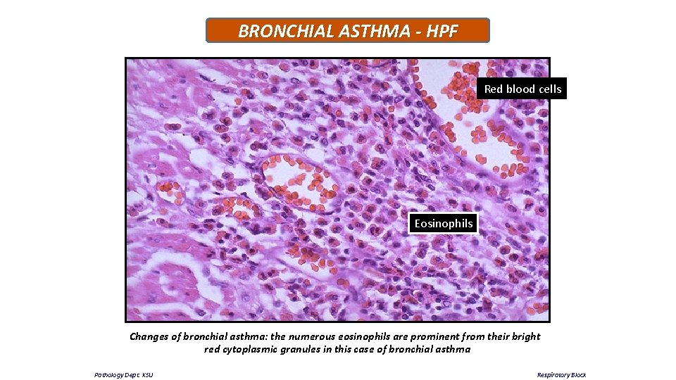 BRONCHIAL ASTHMA - HPF Red blood cells Eosinophils Changes of bronchial asthma: the numerous