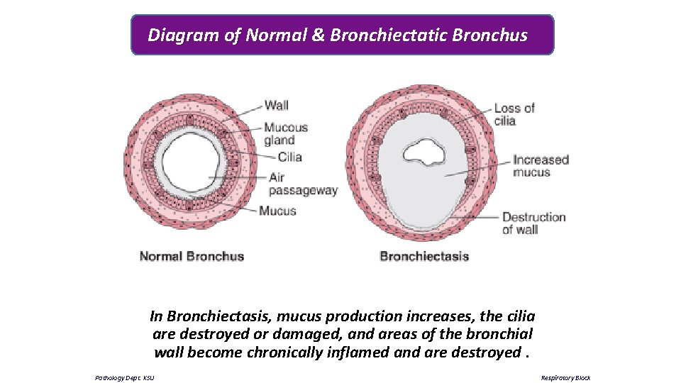 Diagram of Normal & Bronchiectatic Bronchus In Bronchiectasis, mucus production increases, the cilia are