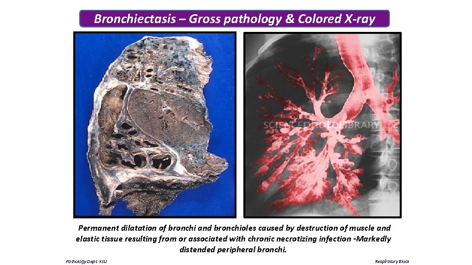 Bronchiectasis – Gross pathology & Colored X-ray Permanent dilatation of bronchi and bronchioles caused