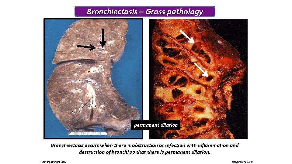 Bronchiectasis – Gross pathology permanent dilation Bronchiectasis occurs when there is obstruction or infection