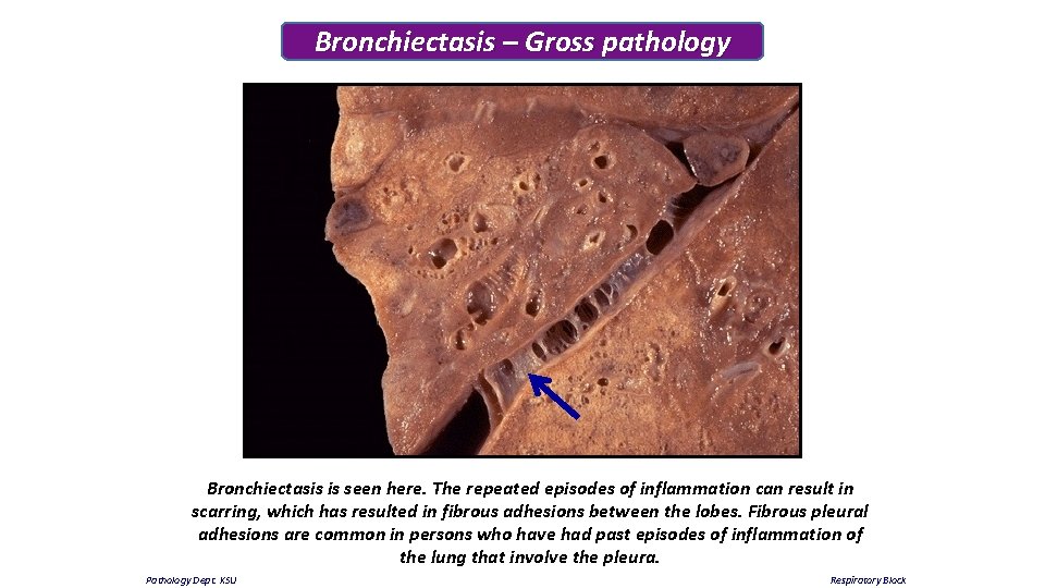 Bronchiectasis – Gross pathology Bronchiectasis is seen here. The repeated episodes of inflammation can