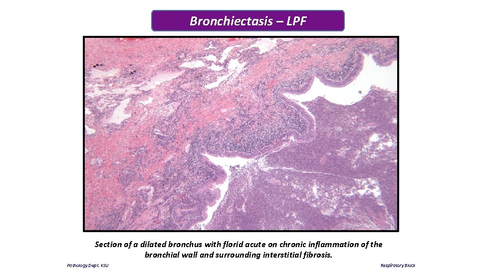 Bronchiectasis – LPF Section of a dilated bronchus with florid acute on chronic inflammation