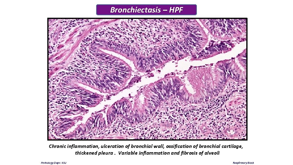 Bronchiectasis – HPF Chronic inflammation, ulceration of bronchial wall, ossification of bronchial cartilage, thickened