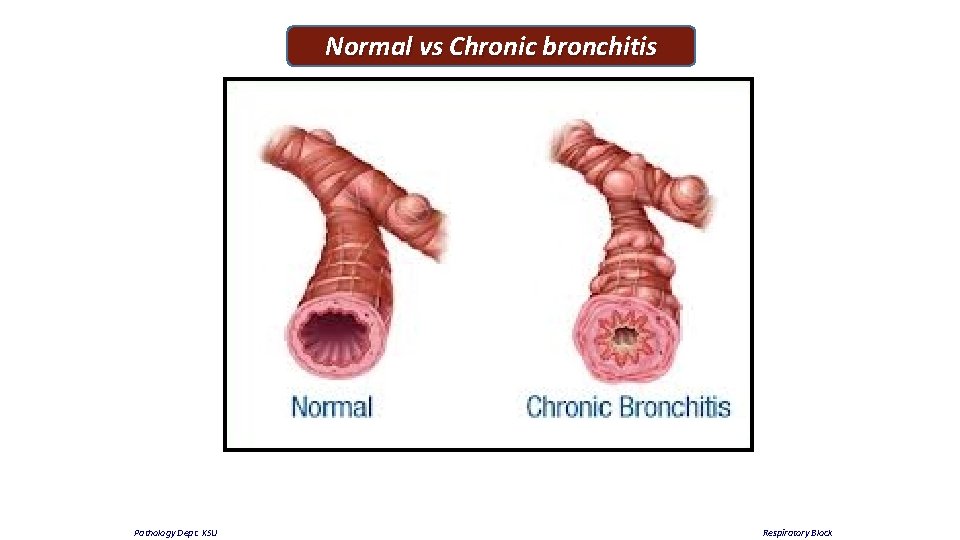 Normal vs Chronic bronchitis Pathology Dept. KSU Respiratory Block 