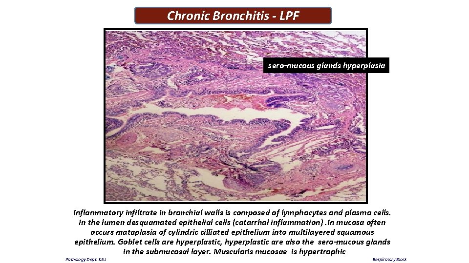 Chronic Bronchitis - LPF sero-mucous glands hyperplasia Inflammatory infiltrate in bronchial walls is composed