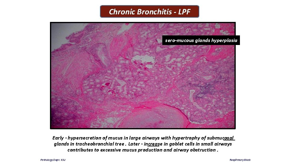 Chronic Bronchitis - LPF sero-mucous glands hyperplasia Early - hypersecretion of mucus in large