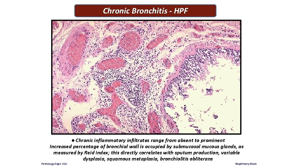 Chronic Bronchitis - HPF ● Chronic inflammatory infiltrates range from absent to prominent Increased