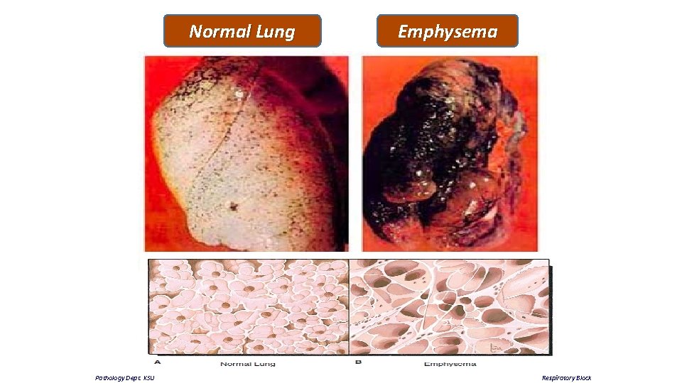 Normal Lung Pathology Dept. KSU Emphysema Respiratory Block 