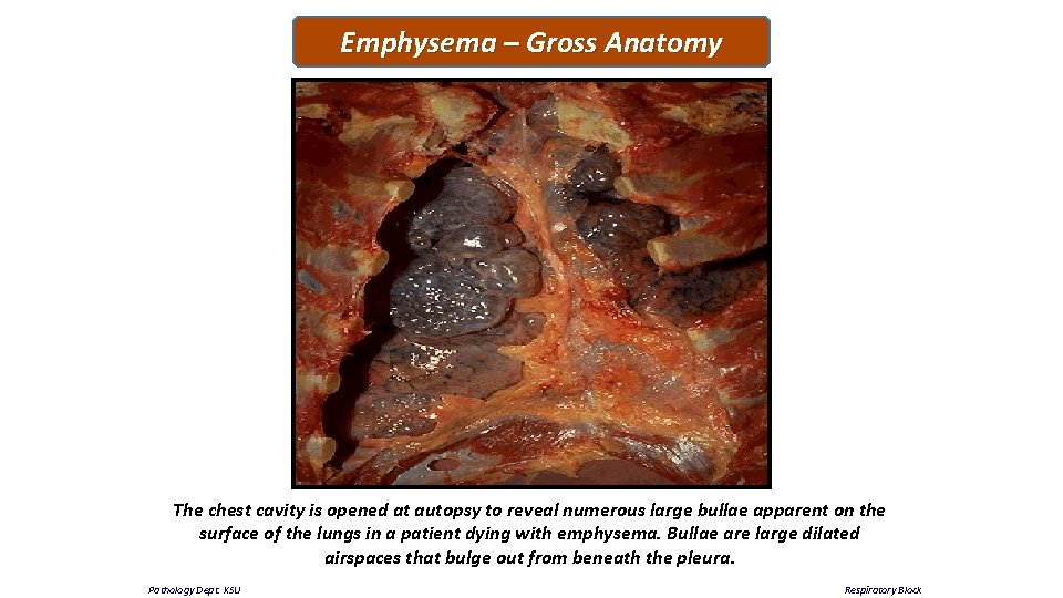 Emphysema – Gross Anatomy The chest cavity is opened at autopsy to reveal numerous