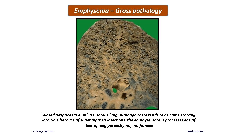 Emphysema – Gross pathology Dilated airspaces in emphysematous lung. Although there tends to be