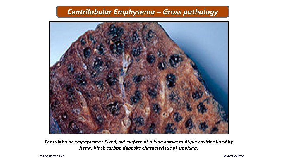 Centrilobular Emphysema – Gross pathology Centrilobular emphysema : Fixed, cut surface of a lung