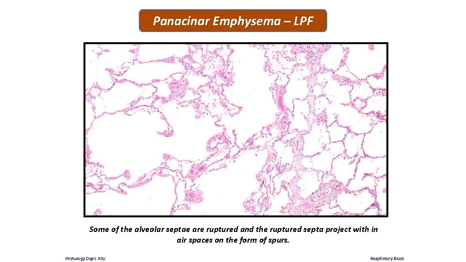 Panacinar Emphysema – LPF Some of the alveolar septae are ruptured and the ruptured