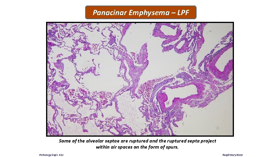 Panacinar Emphysema – LPF Some of the alveolar septae are ruptured and the ruptured