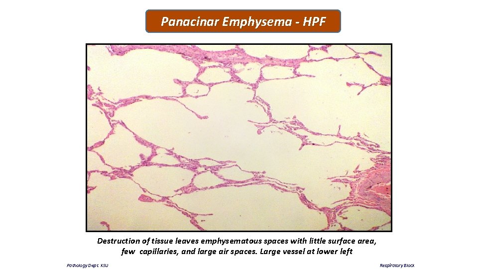 Panacinar Emphysema - HPF Destruction of tissue leaves emphysematous spaces with little surface area,
