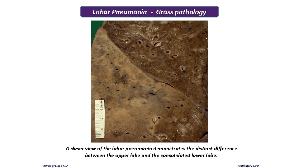 Lobar Pneumonia - Gross pathology A closer view of the lobar pneumonia demonstrates the