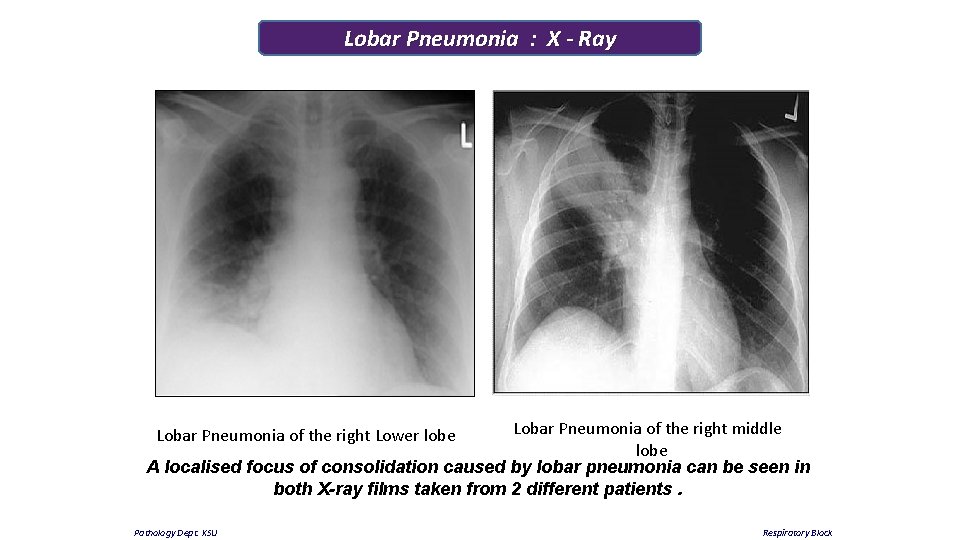 Lobar Pneumonia : X - Ray Lobar Pneumonia of the right middle lobe A