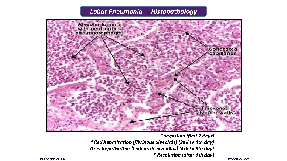 Lobar Pneumonia - Histopathology Pathology Dept. KSU * Congestion (first 2 days) * Red