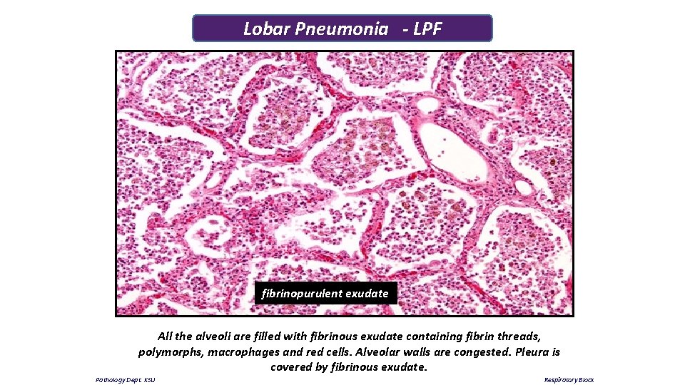 Lobar Pneumonia - LPF fibrinopurulent exudate All the alveoli are filled with fibrinous exudate