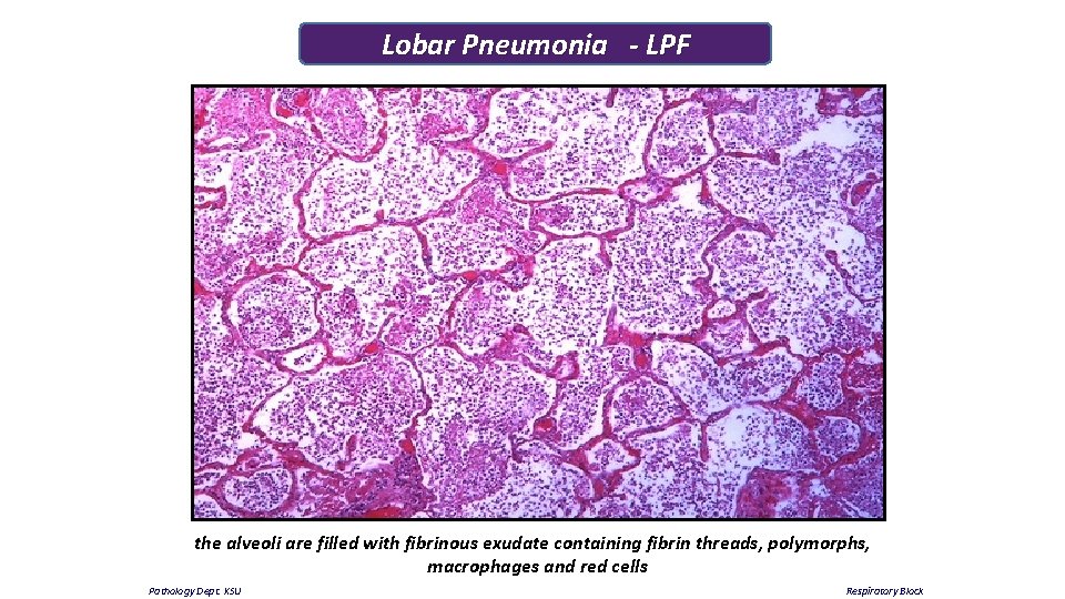 Lobar Pneumonia - LPF the alveoli are filled with fibrinous exudate containing fibrin threads,