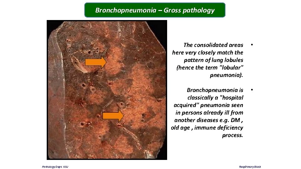 Bronchopneumonia – Gross pathology The consolidated areas • here very closely match the pattern