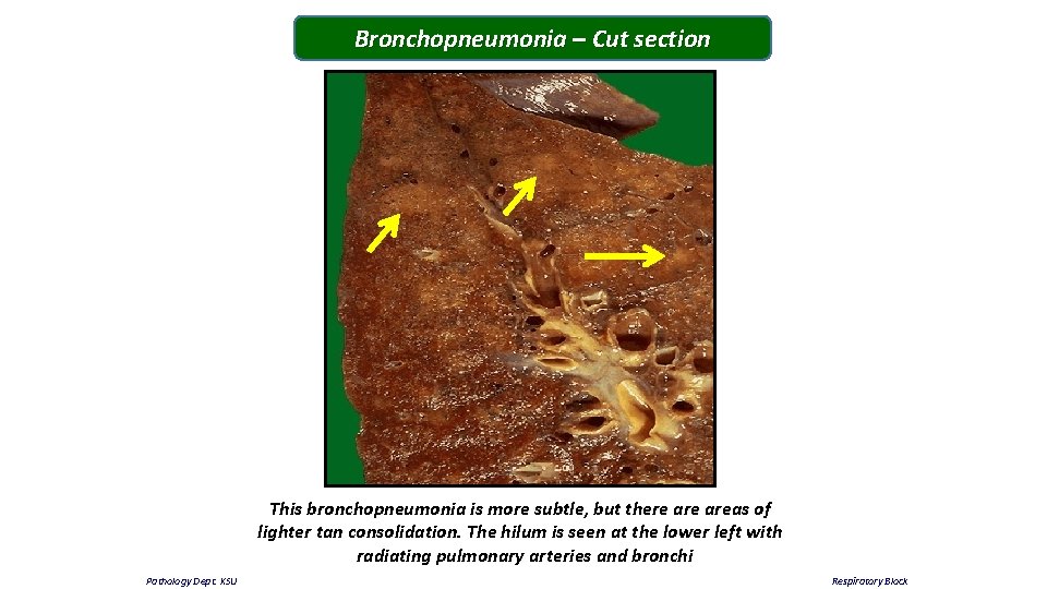 Bronchopneumonia – Cut section This bronchopneumonia is more subtle, but there areas of lighter