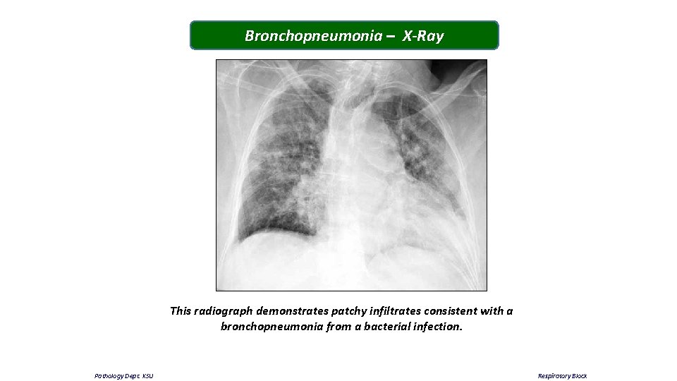 Bronchopneumonia – X-Ray This radiograph demonstrates patchy infiltrates consistent with a bronchopneumonia from a