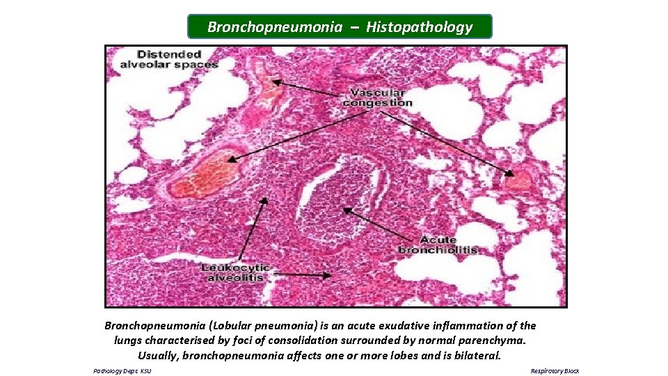 Bronchopneumonia – Histopathology Bronchopneumonia (Lobular pneumonia) is an acute exudative inflammation of the lungs