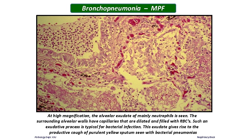 Bronchopneumonia – MPF At high magnification, the alveolar exudate of mainly neutrophils is seen.