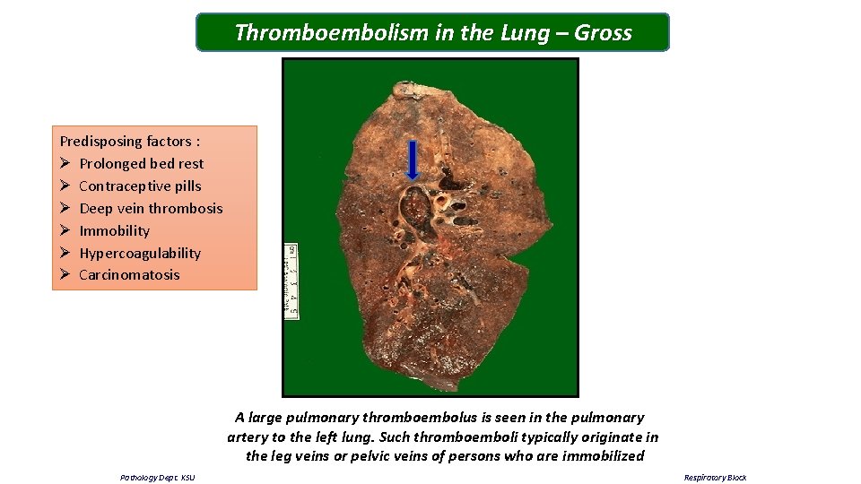 Thromboembolism in the Lung – Gross Predisposing factors : Ø Prolonged bed rest Ø