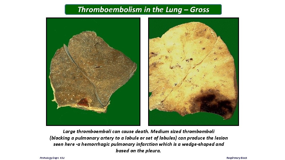 Thromboembolism in the Lung – Gross Large thromboemboli can cause death. Medium sized thrombomboli