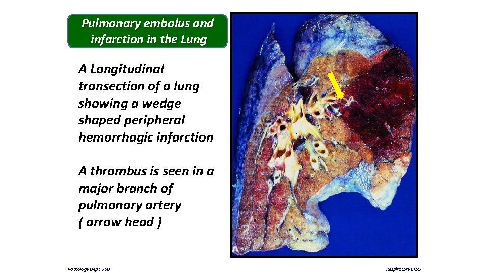 Pulmonary embolus and infarction in the Lung A Longitudinal transection of a lung showing