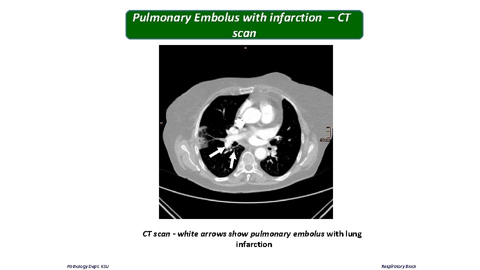 Pulmonary Embolus with infarction – CT scan - white arrows show pulmonary embolus with