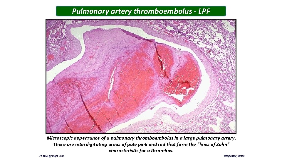 Pulmonary artery thromboembolus - LPF Microscopic appearance of a pulmonary thromboembolus in a large