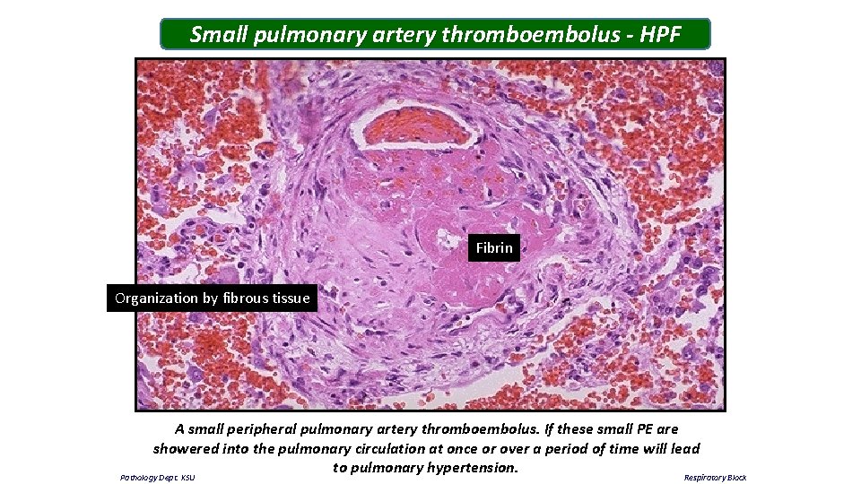 Small pulmonary artery thromboembolus - HPF Fibrin Organization by fibrous tissue A small peripheral