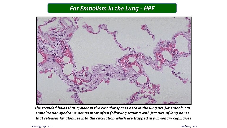 Fat Embolism in the Lung - HPF The rounded holes that appear in the