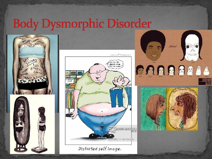 Body Dysmorphic Disorder 