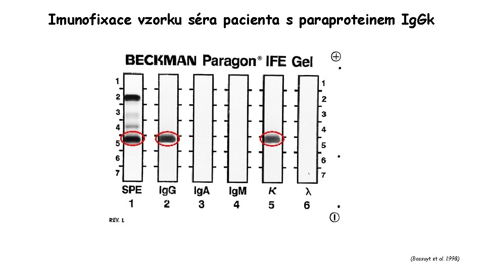 Imunofixace vzorku séra pacienta s paraproteinem Ig. Gk (Bossuyt et al. 1998) 