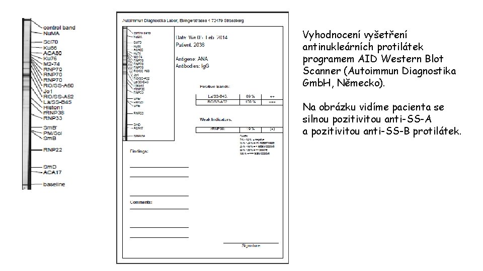 Vyhodnocení vyšetření antinukleárních protilátek programem AID Western Blot Scanner (Autoimmun Diagnostika Gmb. H, Německo).