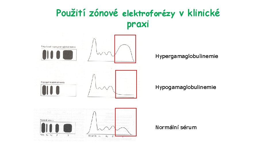 Použití zónové elektroforézy v klinické praxi Hypergamaglobulinemie Hypogamaglobulinemie Normální sérum 