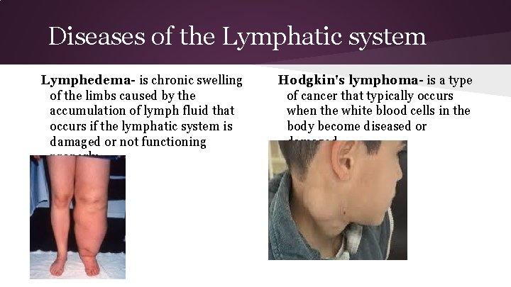 Diseases of the Lymphatic system Lymphedema- is chronic swelling of the limbs caused by