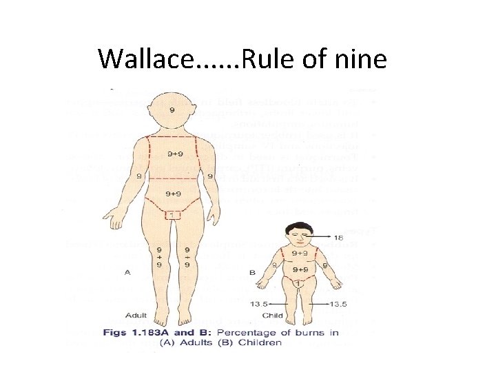 Wallace. . . Rule of nine 