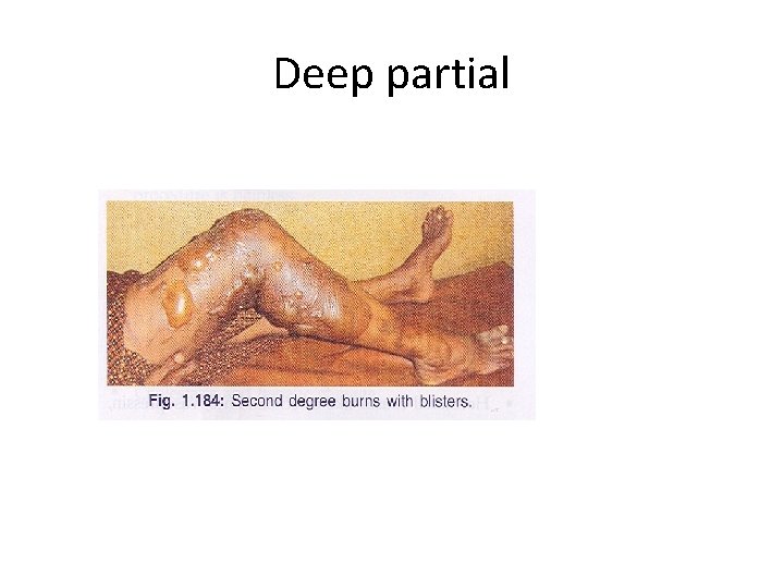 Deep partial 